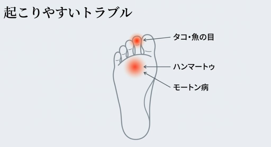 タコや魚の目ができやすい荷重バランスの注意点